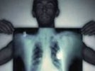 В Первоуральске остается острой ситуация по заболеваемости туберкулезом